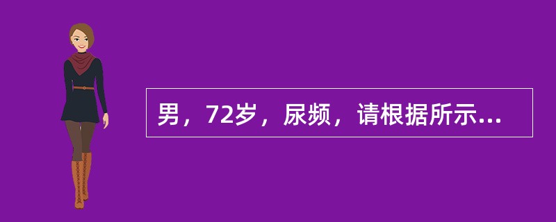 男，72岁，尿频，请根据所示图像作出最可能诊断()<img border="0" style="width: 201px; height: 151px;"