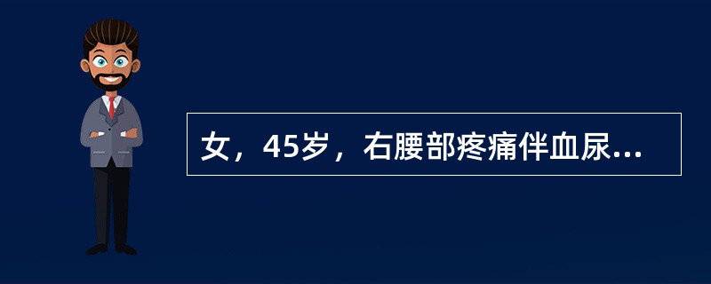 女，45岁，右腰部疼痛伴血尿，请根据所示图像，选择最可能诊断()<img border="0" style="width: 191px; height: 143px