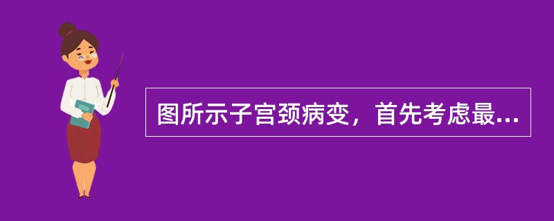 图所示子宫颈病变，首先考虑最可能的病理诊断是<img border="0" style="width: 188px; height: 125px;" sr