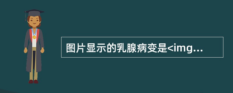 图片显示的乳腺病变是<img border="0" style="width: 186px; height: 126px;" src="http