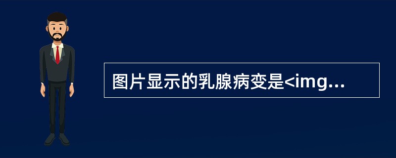 图片显示的乳腺病变是<img border="0" style="width: 331px; height: 128px;" src="http