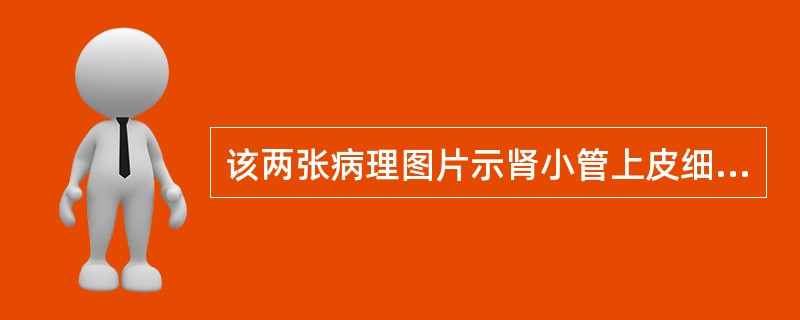 该两张病理图片示肾小管上皮细胞脱落，其诊断为()<img border="0" style="width: 303px; height: 182px;"