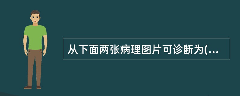 从下面两张病理图片可诊断为()<img border="0" style="width: 350px; height: 208px;" src="