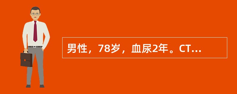 男性，78岁，血尿2年。CT示右侧肾盂内可见软组织密度影，肾盂肾盏受压变形，考虑为肾脏肿瘤，遂行右肾切除，肾脏大体如图所示，镜检如图所示，请做出诊断()<img border="0&q