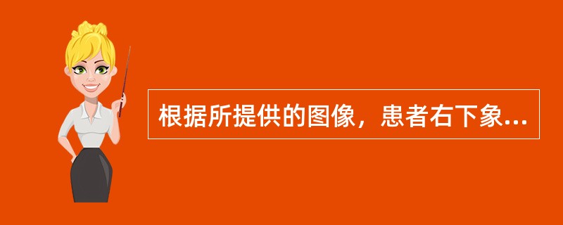 根据所提供的图像，患者右下象限病灶的最可能的诊断为()<img border="0" style="width: 230px; height: 172px;&quo