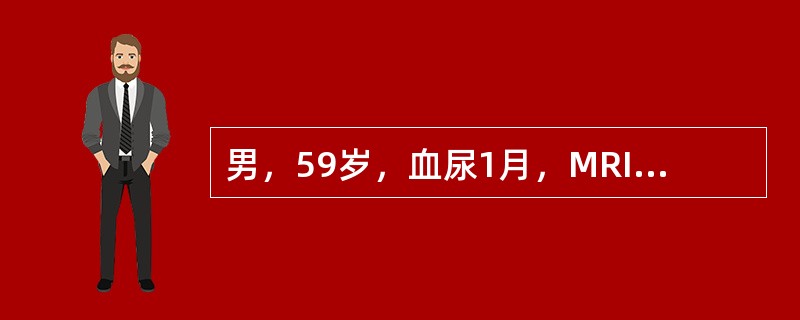 男，59岁，血尿1月，MRI检查如图所示。最可能的诊断是()<img border="0" style="width: 223px; height: 167px;&