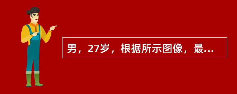 男，27岁，根据所示图像，最可能的诊断是()<img border="0" style="width: 171px; height: 128px;" sr