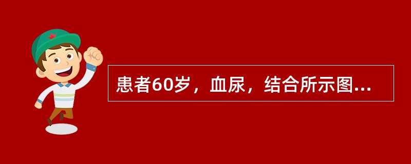 患者60岁，血尿，结合所示图像，结合所示图像，最可能的诊断是()<img border="0" style="width: 182px; height: 136px