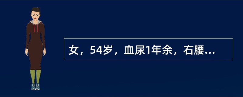 女，54岁，血尿1年余，右腰痛10天余，CT右肾下极60mm×70mm肿块，突出肾外，中心有不规则低密度区，增强扫描早期病灶明显强化，中心低密度区无强化。最可能的诊断为()