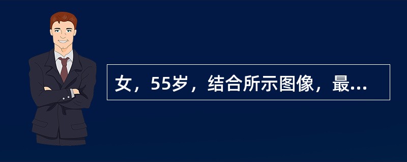 女，55岁，结合所示图像，最可能的诊断是()<img border="0" style="width: 210px; height: 158px;" sr