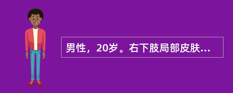 男性，20岁。右下肢局部皮肤红、肿、热、痛，中央局部缺血坏死，流出脓液稀薄，粉红色，致病菌是