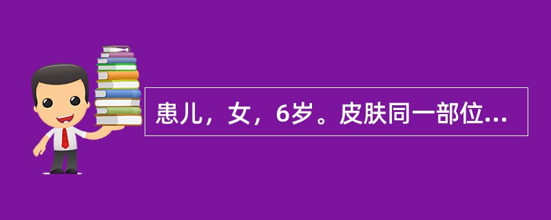 患儿，女，6岁。皮肤同一部位出现丘疹、水疱，有的水疱内含清亮液体，有的呈浊性液，还有的已破溃结痂。护士根据患儿皮疹特点考虑是