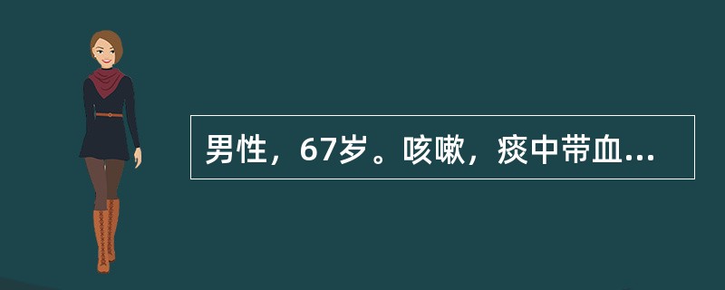 男性，67岁。咳嗽，痰中带血丝2个月，发热10天，胸片显示右肺上叶片状阴影，呈肺炎样征象。病人1个月后出现右面部无汗，瞳孔缩小，上睑下垂及眼球内陷。复查胸片显示右胸顶部致密块影，诊断最可能是