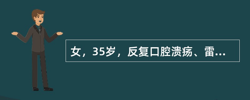 女，35岁，反复口腔溃疡、雷诺现象3年，近1个月乏力、脱发、低热，化验血常规血小板38×109/L，ANA、抗SSA、SSB抗体阳性，最可能的诊断是（　　）。