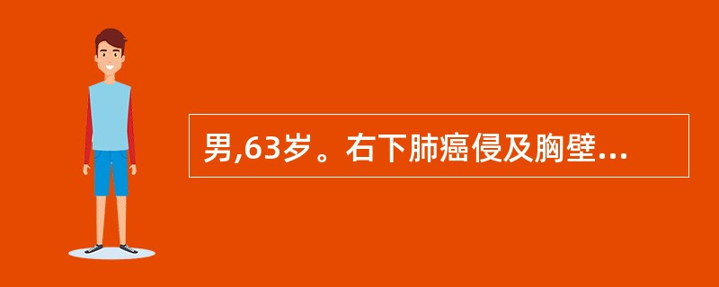 男,63岁。右下肺癌侵及胸壁,胸部CT显示肺门、纵隔无肿大淋巴结,未发现远处转移