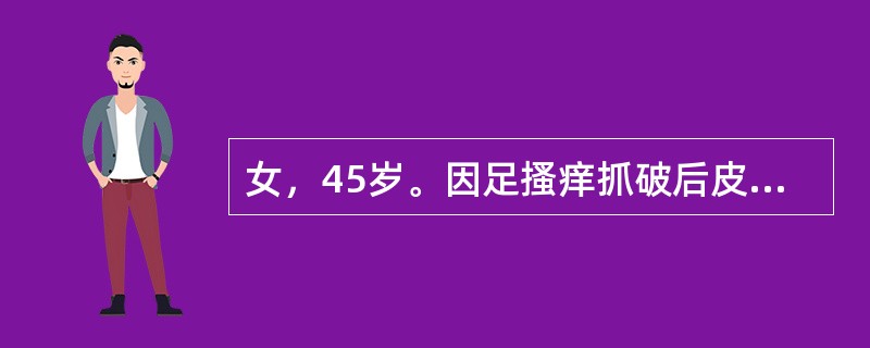 女，45岁。因足搔痒抓破后皮肤破溃，继而于小腿及大腿中下段出现一红线，压痛，患肢轻度肿胀，诊断考虑为（　　）。