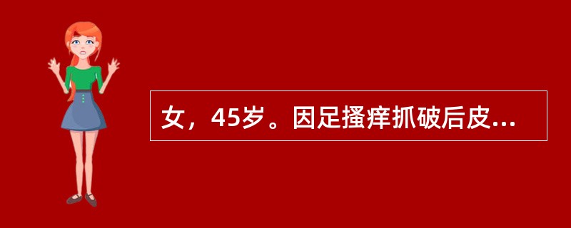 女，45岁。因足搔痒抓破后皮肤破溃，继而于小腿及大腿中下段出现一红线，压痛，患肢轻度肿胀，诊断考虑为（　　）。