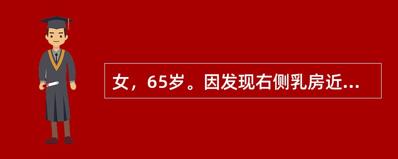 女，65岁。因发现右侧乳房近乳头处包块半年来院就诊，既往体健。查体：右侧乳腺外上象限近乳头处可触及约3cm×5cm质硬肿物，无压痛，边界尚清，右侧腋窝可及肿大淋巴结但尚可推动，左侧腋窝未触及明显肿大淋