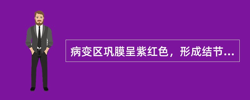 病变区巩膜呈紫红色，形成结节样隆起的巩膜炎类型是（　　）。