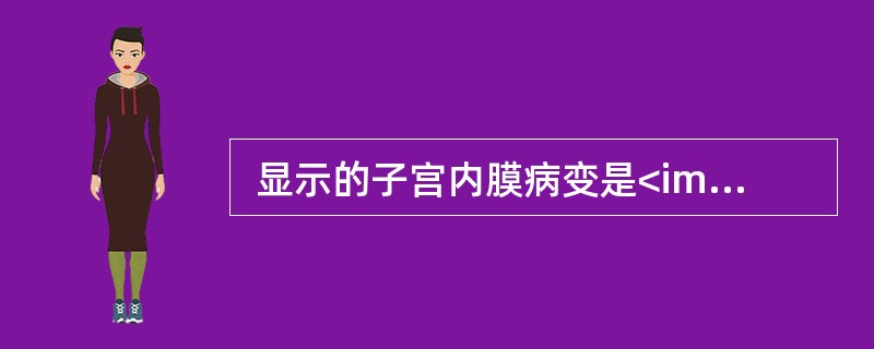  显示的子宫内膜病变是<img border="0" src="https://img.zhaotiba.com/fujian/20220820/ggqj