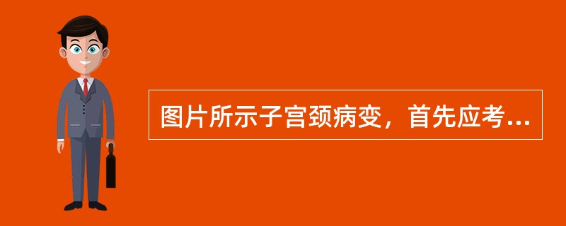 图片所示子宫颈病变，首先应考虑的病理诊断是<img border="0" src="https://img.zhaotiba.com/fujian/20220820