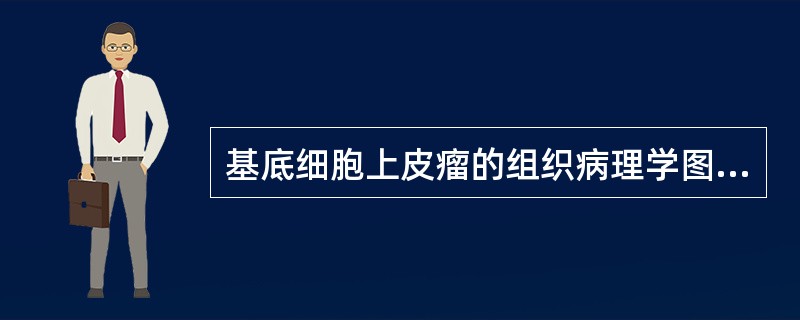 基底细胞上皮瘤的组织病理学图像中最具有诊断意义的特点包括（　　）。