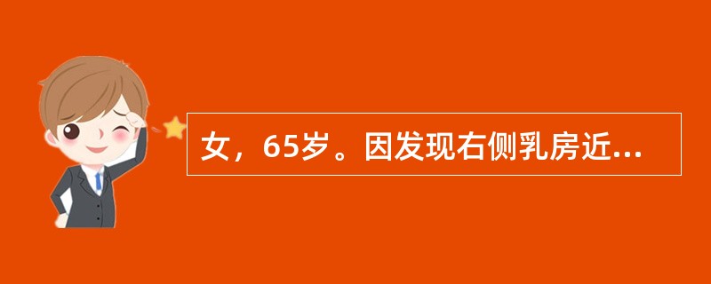 女，65岁。因发现右侧乳房近乳头处包块半年来院就诊，既往体健。查体：右侧乳腺外上象限近乳头处可触及约3cm×5cm质硬肿物，肿物局部皮肤稍凹陷，无压痛，边界尚清，腋窝未触及明显肿大淋巴结。提示：乳腺钼