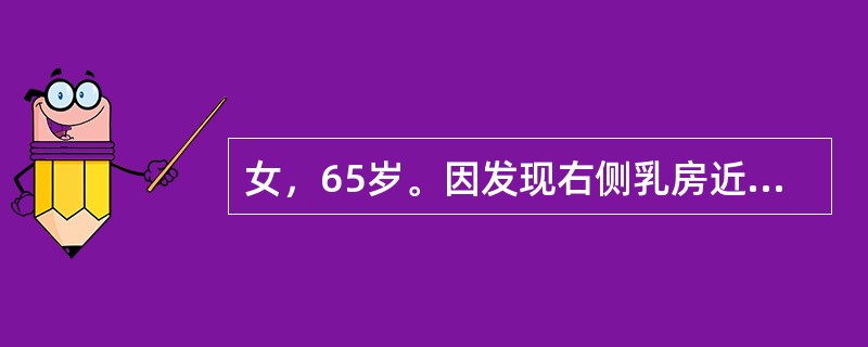 女，65岁。因发现右侧乳房近乳头处包块半年来院就诊，既往体健。查体：右侧乳腺外上象限近乳头处可触及约3cm×5cm质硬肿物，肿物局部皮肤稍凹陷，无压痛，边界尚清，腋窝未触及明显肿大淋巴结。提示：行右侧