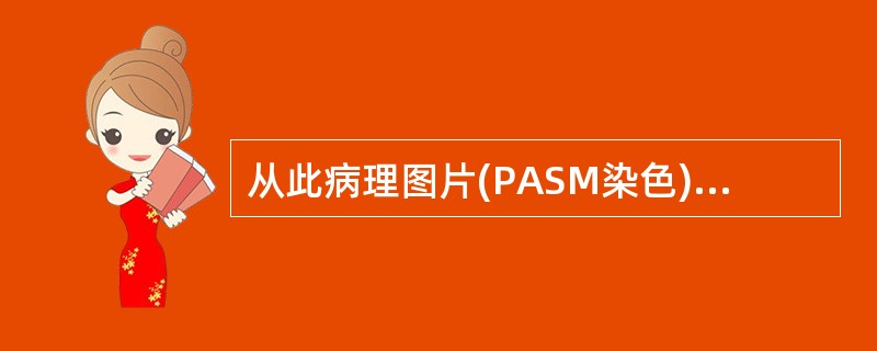 从此病理图片(PASM染色)可见GBM空泡变性(Ⅴ),考虑为 ( )