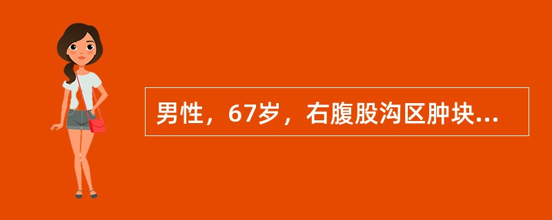 男性，67岁，右腹股沟区肿块1年，渐增大，但晚间卧床后肿块缩小。昨突发右下腹痛，伴呕吐2次，腹痛阵发性加重。体格检查：全腹平软，右下腹压痛，无肌紧张，肠鸣音8～12次／分，偶闻气过水声。最可能的诊断是