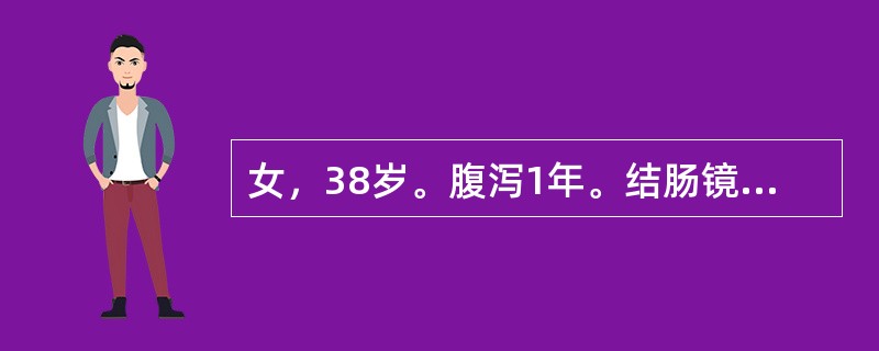 女，38岁。腹泻1年。结肠镜示回盲部纵行溃疡和裂隙样溃疡，肠黏膜活检最有诊断意义的病理改变是