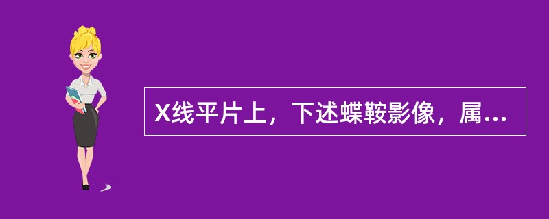 X线平片上，下述蝶鞍影像，属于正常蝶鞍影像的是