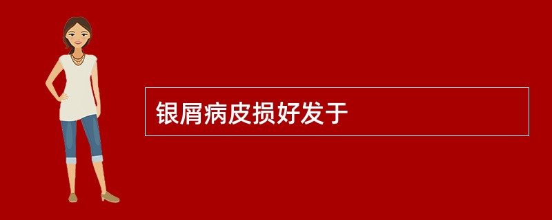 银屑病皮损好发于